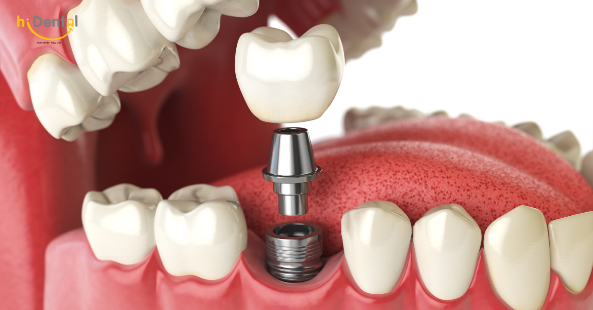 Trồng Răng Implant Uy Tín
