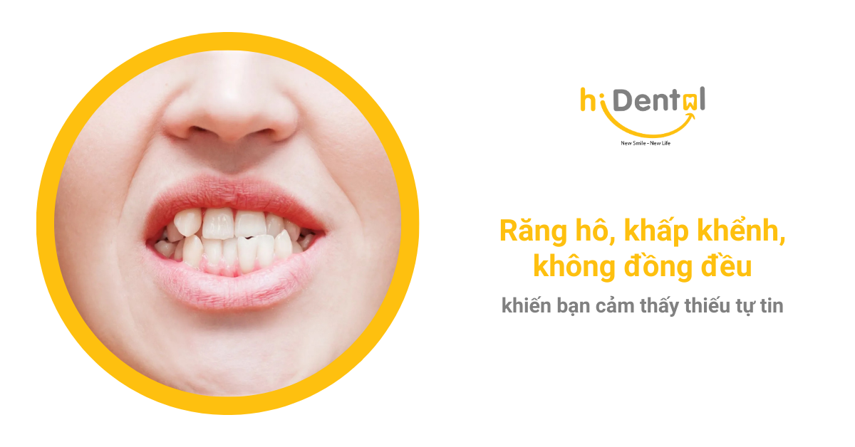 Nha Khoa Chuyên Niềng Răng