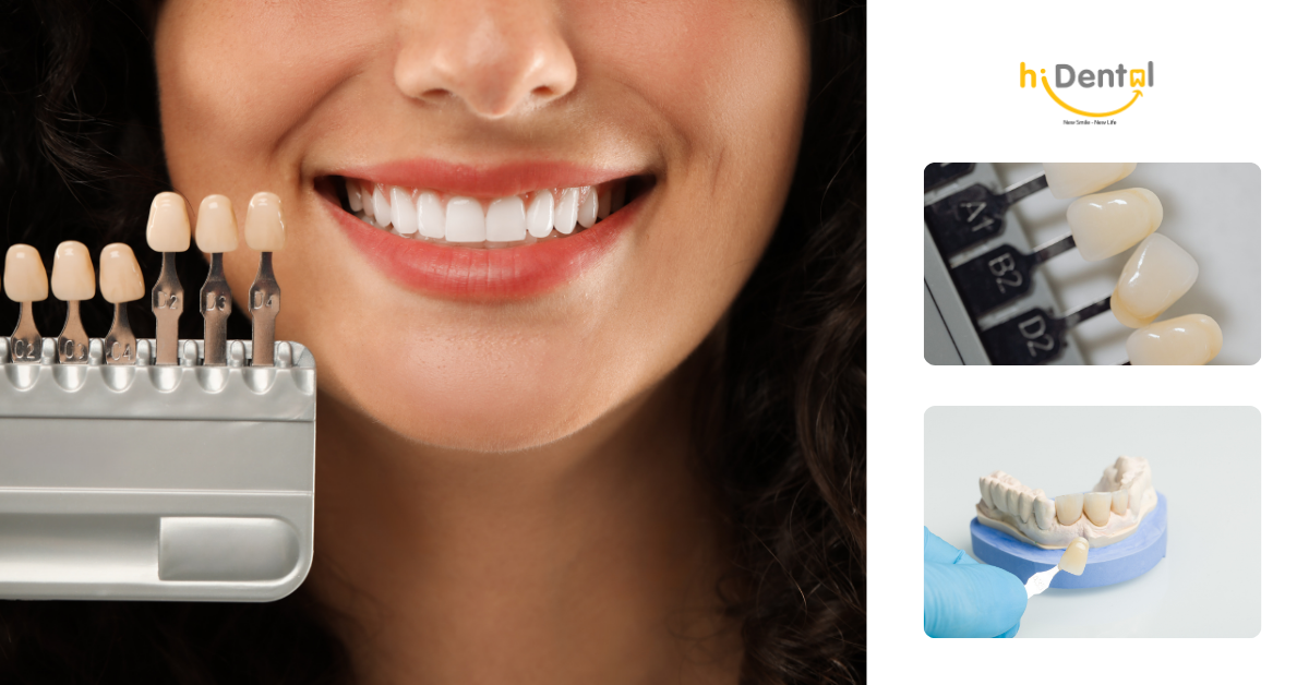 Làm răng sứ veneer mang lại hiệu quả cao, chi phí hợp lý
