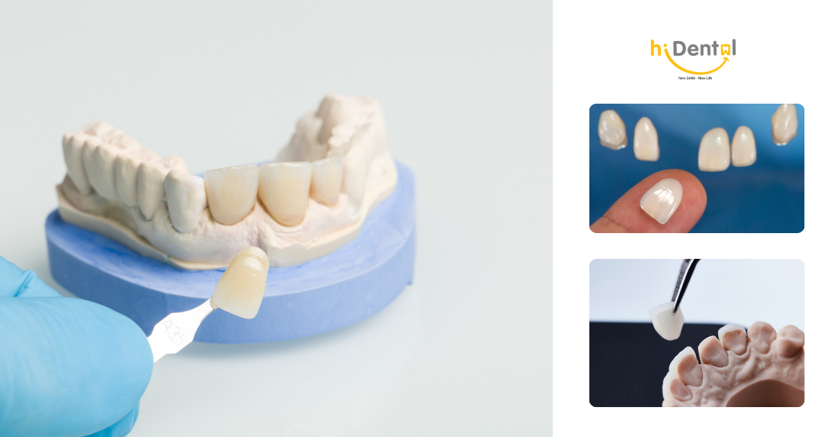 Có nhiều loại veneer để khách hàng lựa chọn
