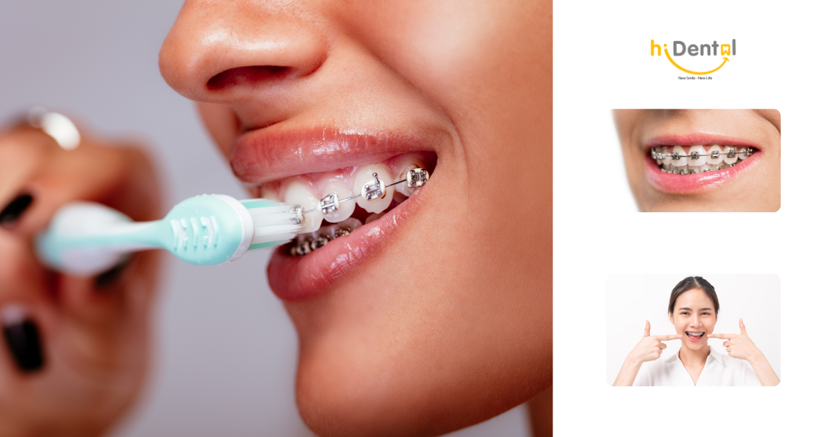 Cần chăm sóc răng sau niềng răng