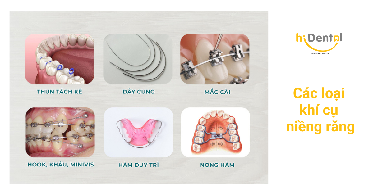 Có nhiều loại khí cụ niềng răng
