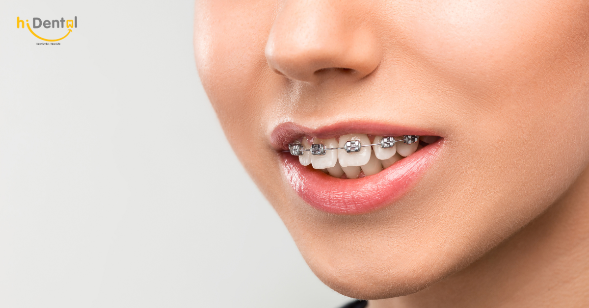 Niềng răng để cải thiện răng hô là phương pháp nhiều khách hàng lựa chọn