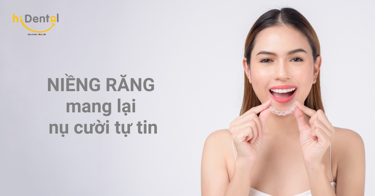 Niềng răng mang lại nụ cười tự tin
