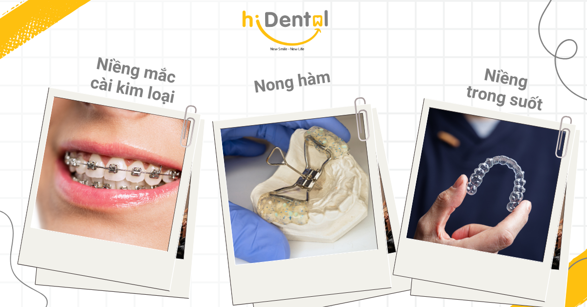 Có nhiều phương pháo niềng răng tăng trưởng cho bé hiện nay
