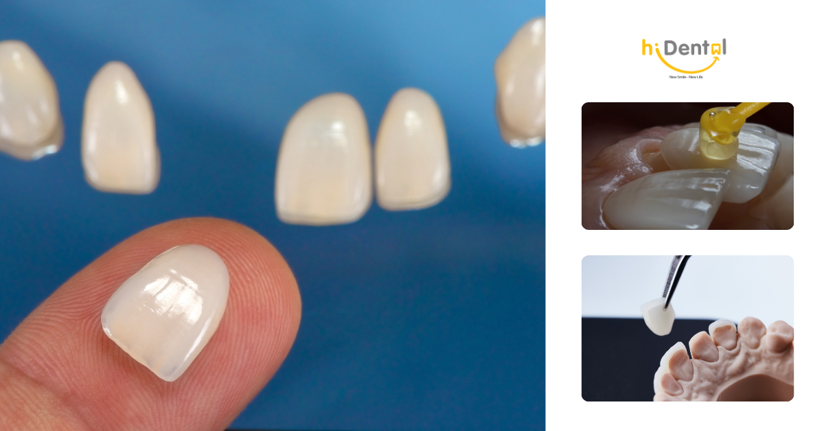 Làm sao để veneer bền lâu là câu hỏi nhiều khách hàng thắc mắc
