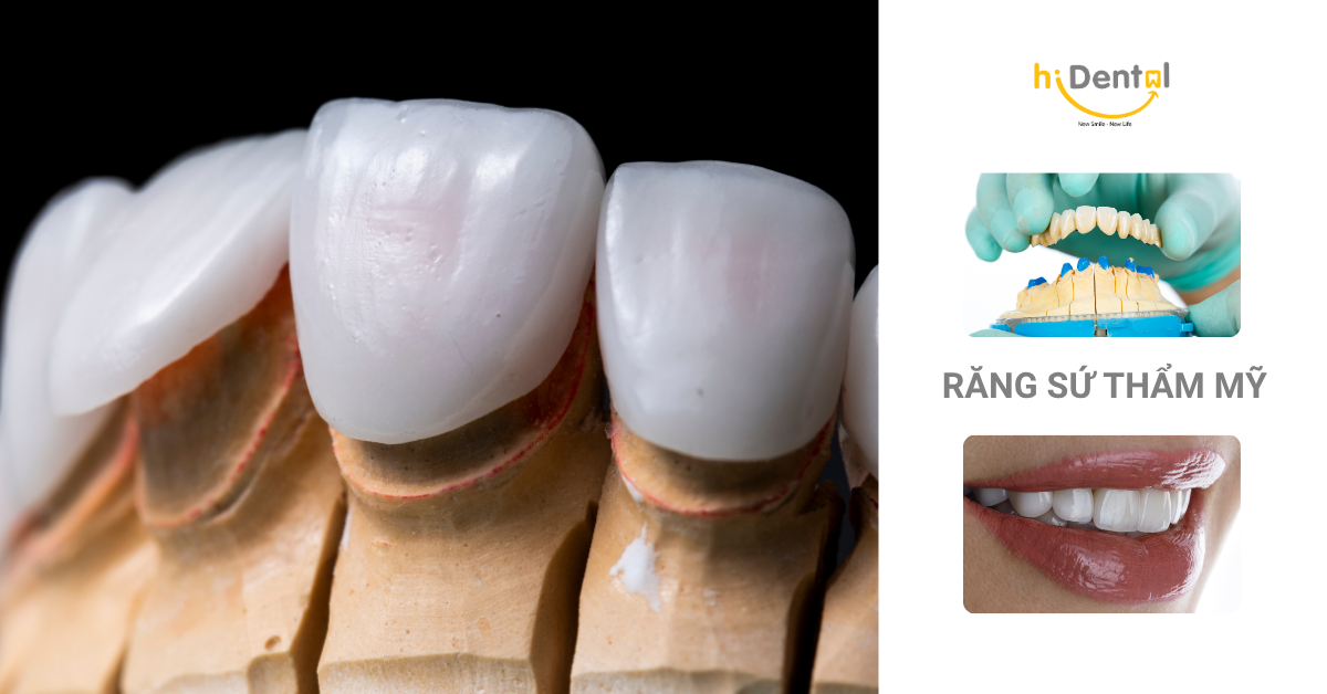 Nên bọc răng sứ 1 răng hay toàn hàm là câu hỏi nhiều khách hàng quan tâm
