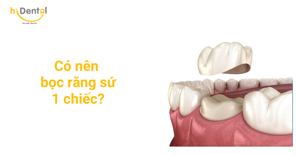 Bọc răng sứ 1 răng là phương pháp thẩm mỹ được nhiều khách hàng sử dụng
