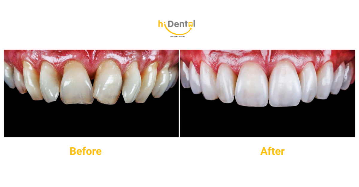 hiDental là nha khoa bọc răng sứ được nhiều khách hàng tin tưởng

