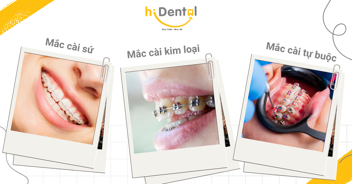 Có nhiều loại mắc cài với chi phí khác nhau
