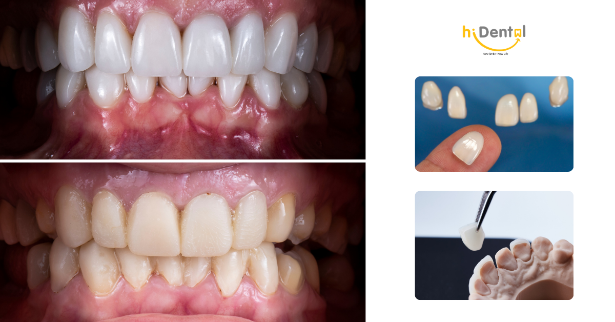 Cần đảm bảo đồng bộ để tăng tính thẩm mỹ khi dán sứ veneer
