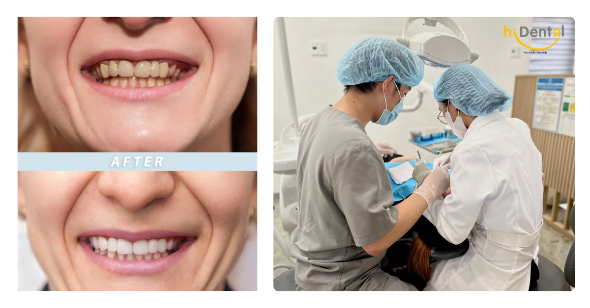 Răng sứ veneer mang lại nhiều lợi ích
