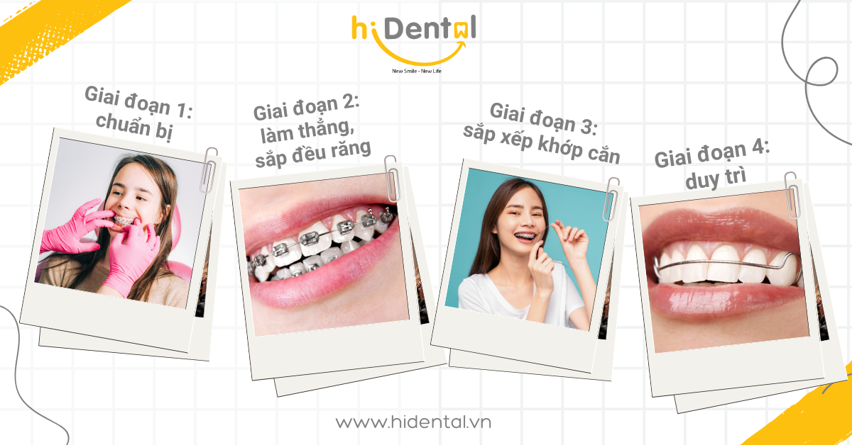 Qúa trình niềng răng tại hiDental thường có 4 giai đoạn chính
