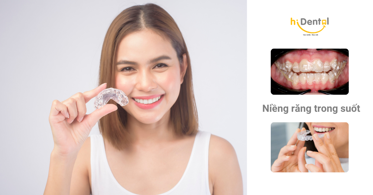 Làm sao để rút ngắn thời gian niềng răng trong suốt là câu hỏi nhiều khách hàng quan tâm
