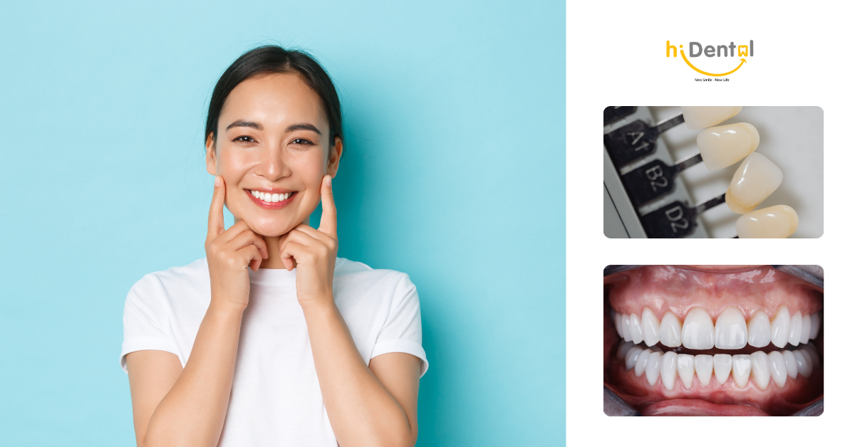 Dán sứ veneer có tốt không là câu hỏi nhiều khách hàng quan tâm
