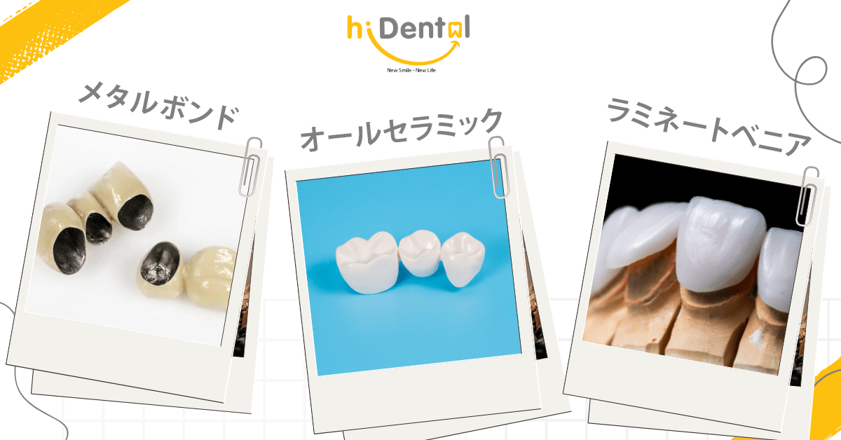 Có nhiều loại răng sứ để khách hàng lựa chọn